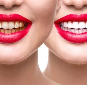 DATE NIGHT WHITE Teeth Whitening INSTANT